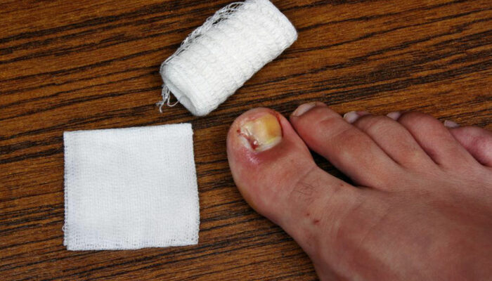 Ways to Treat Toe Nail Fungus During Pregnancy