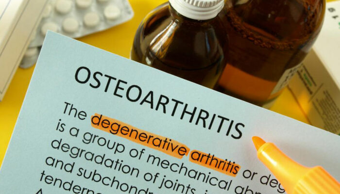 What are the treatment options for managing osteoarthritis