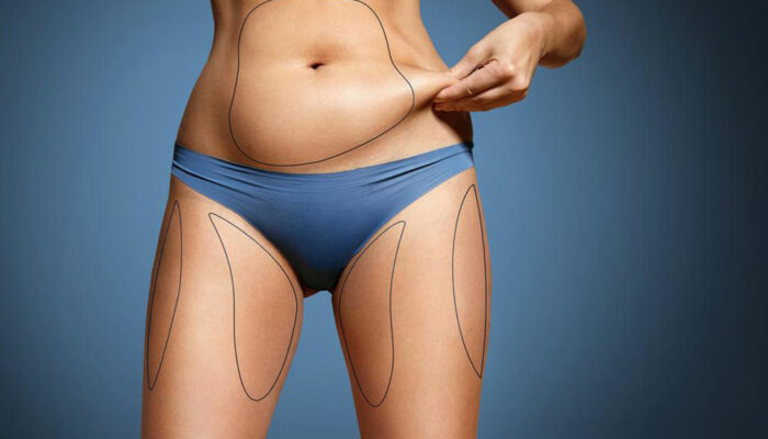 What is coolsculpting fat freezing?