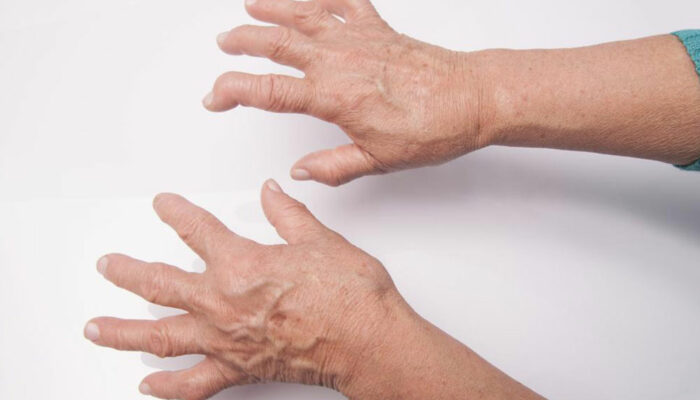 What you need to know about Rheumatoid Arthritis and Lupus