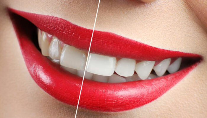 Yellow Teeth &#8211; How to avoid discoloration of teeth