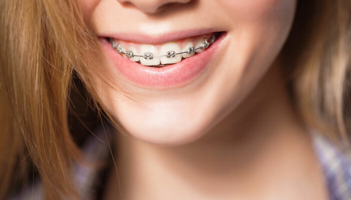 4 common types of teeth braces for adults