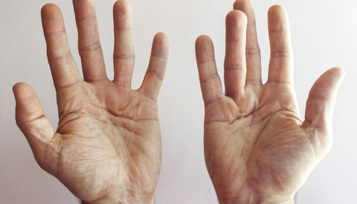 4 hand exercises for Dupuytren&#8217;s contracture patients