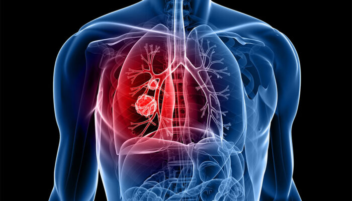 5 cities with the highest rates of lung cancer