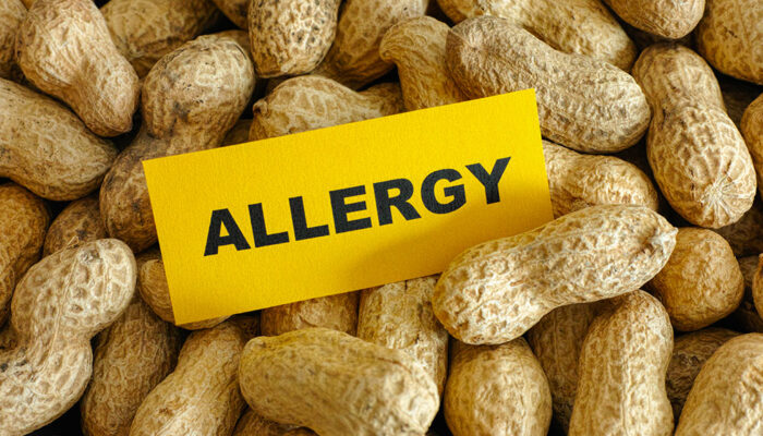 5 most common food allergies