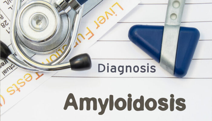 5 natural treatment options for amyloidosis