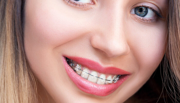 5 things you should know before you get braces