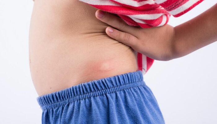 6 Daily Activities That Help In Shingles Rash Treatment