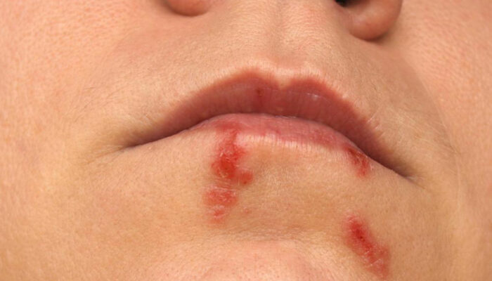 6 Effective Remedies for Treating Cold Sores