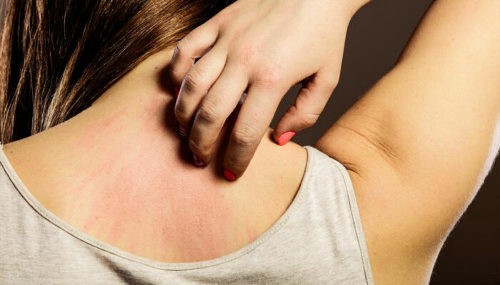 6 Natural Ways for Instant Relief from Itchy Skin