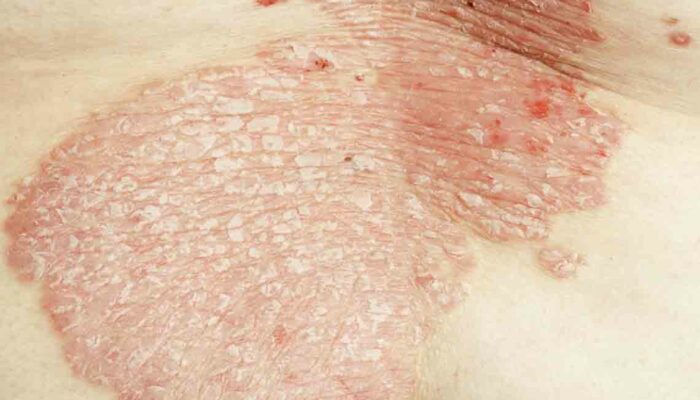 7 Common Types of Eczema