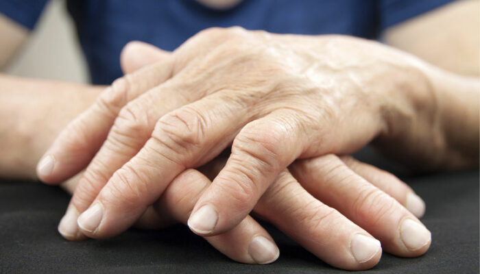 7 tips for living better with rheumatoid arthritis