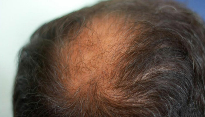 8 Effective Home Remedies for Thinning Hair