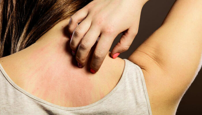 8 Simple Tips to Treat an Eczema Rash