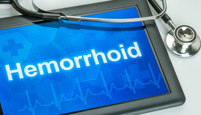 8 Ways to Treat Hemorrhoids