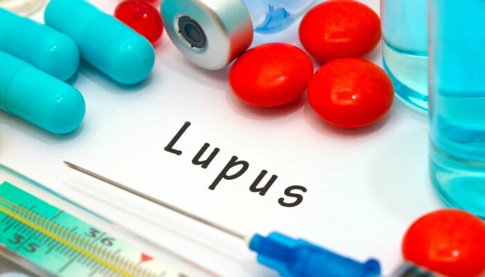 9 Early Signs and Symptoms of Lupus