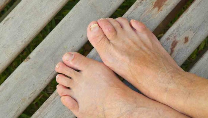 9 Simple Home Remedies to Cure Toenail Fungus