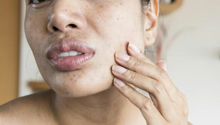 9 Symptoms of Lupus Women Should Know About