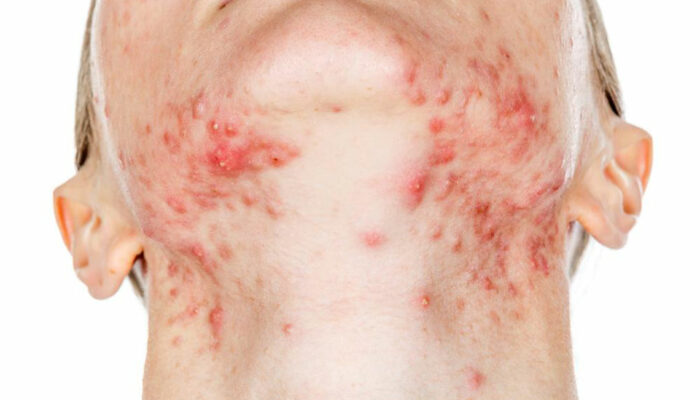 10 Effective Home Remedies to Cure Shingles