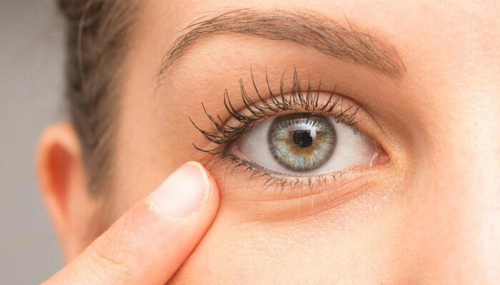 10 Tips to Remove Under-Eye Bags