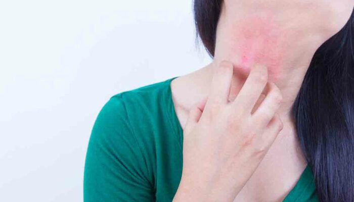 10 over-the-counter treatments for eczema that offer better results