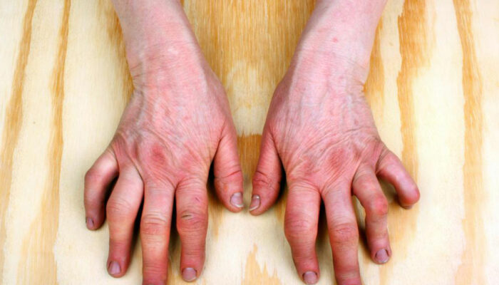 A Brief Overview of Rheumatoid Arthritis