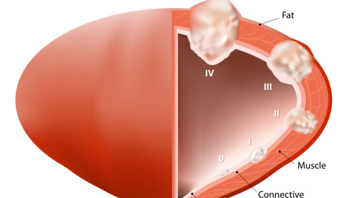 A Guide To Understanding Bladder Cancer