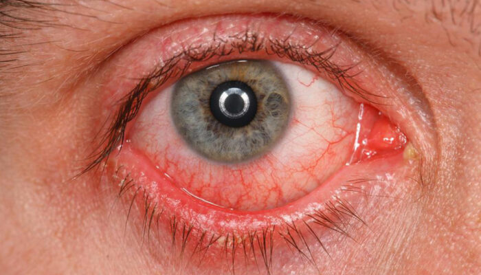 A Few Common Symptoms, Causes, And Treatments of Pink Eyes