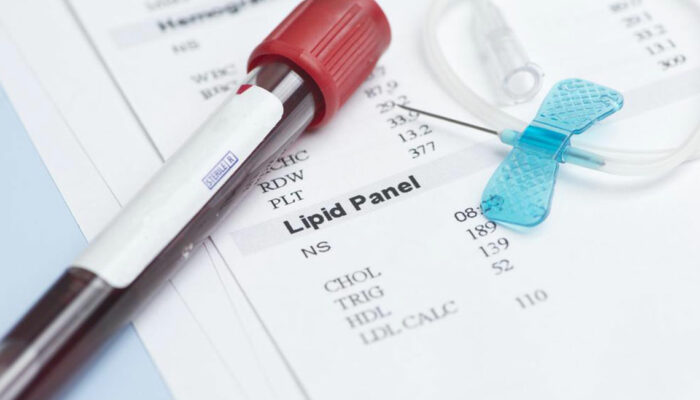 A Few Essential Things to Know about Lipoprotein Profile