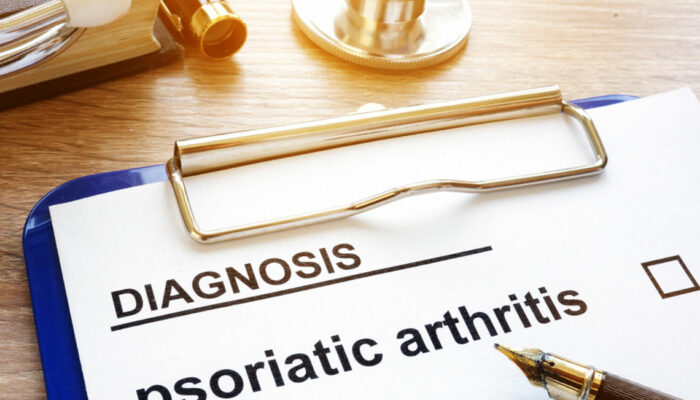 A guide to the symptoms of psoriatic arthritis