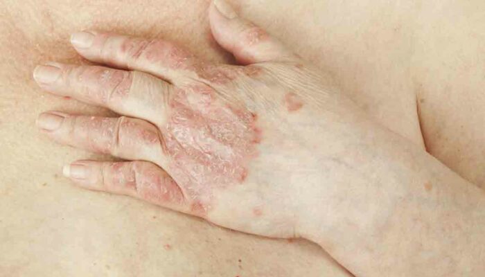 All the Information on Psoriasis You Need to Know