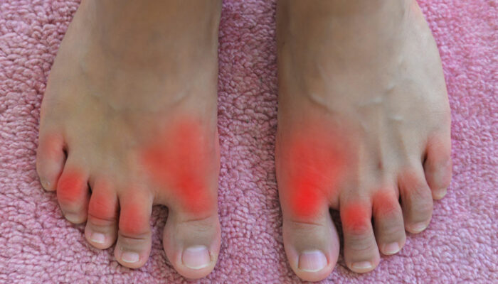 All you need to Know about Gout and Its Treatment