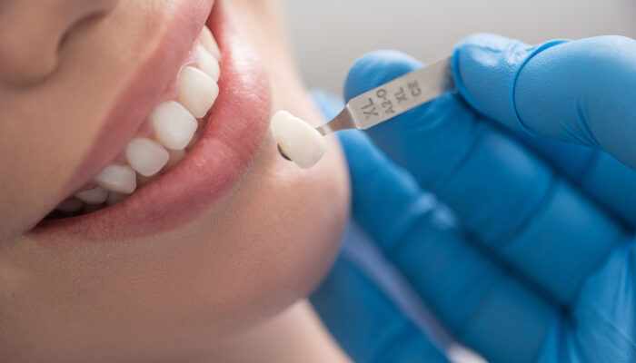 All you need to know about dental crowns and caps