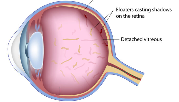 All About Eye Floaters And How To Get Rid Of Them