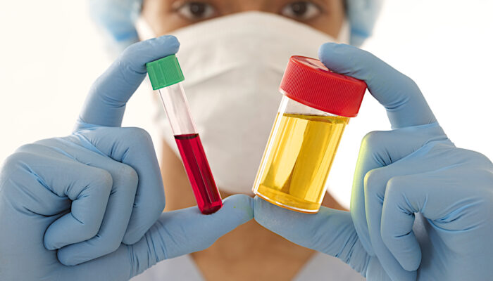 All You Need To Know About Blood In Urine