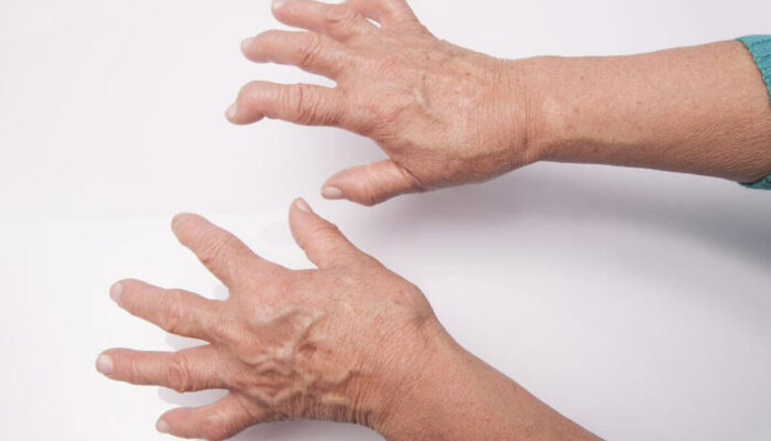 All You Need to Know About the Diagnosis of Rheumatoid Arthritis