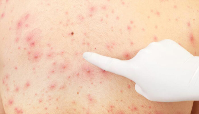 All You Need to Know About Pityriasis Rosea Treatments