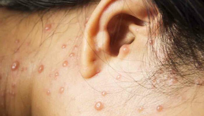 All You Need to Know About Shingles