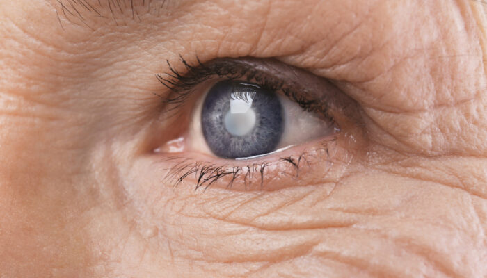 All You Need to Know about Cataract