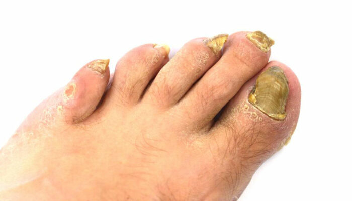 An Effective Way to Treat Toenail Fungus &#8211; Hydrogen Peroxide