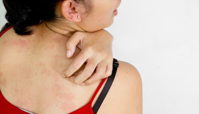 Atopic Dermatitis- Causes, Symptoms And Treatment