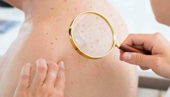 Atopic Dermatitis Eczema &#8211; Causes, Symptoms, and Treatments