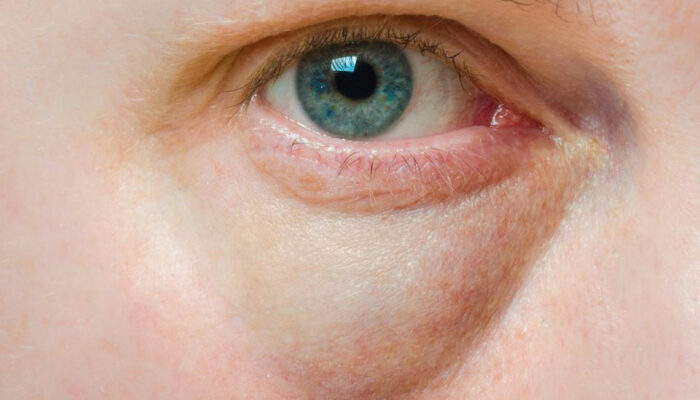 Bags Under the Eyes &#8211; Symptoms, Causes, and Treatment