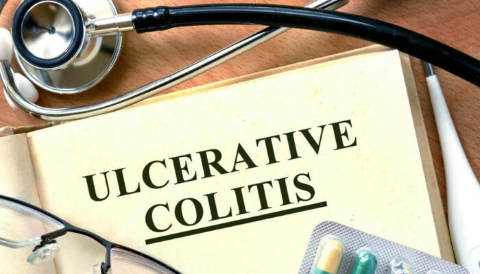 Beating Ulcerative Colitis Flares