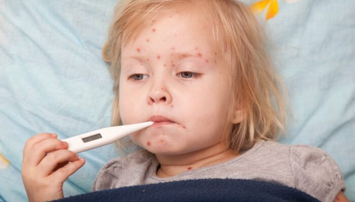 Causes, Symptoms, and Treatment of Measles