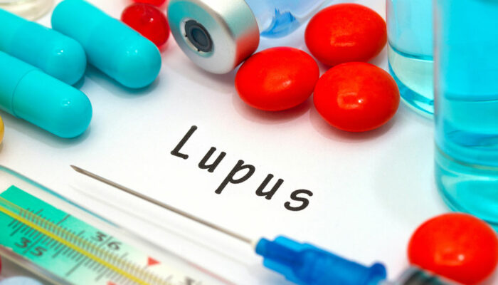 Causes and Symptoms of Lupus