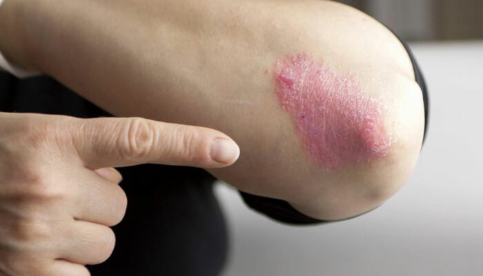 Chronic Plaque Psoriasis And its Effective Treatment