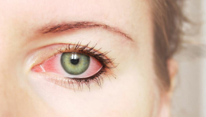 Common Causes and Treatments for Red Eye