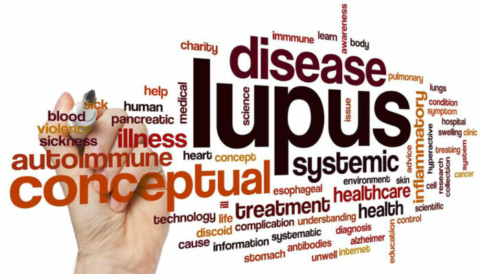 Common Symptoms of Lupus in Women