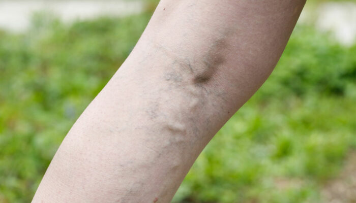 Common Symptoms and Treatments for Varicose Veins